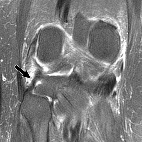 The Posterolateral Corner of the Knee | AJR