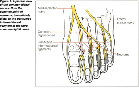 Figure 1 From Mortons Neuroma Getting Patients Back On Track