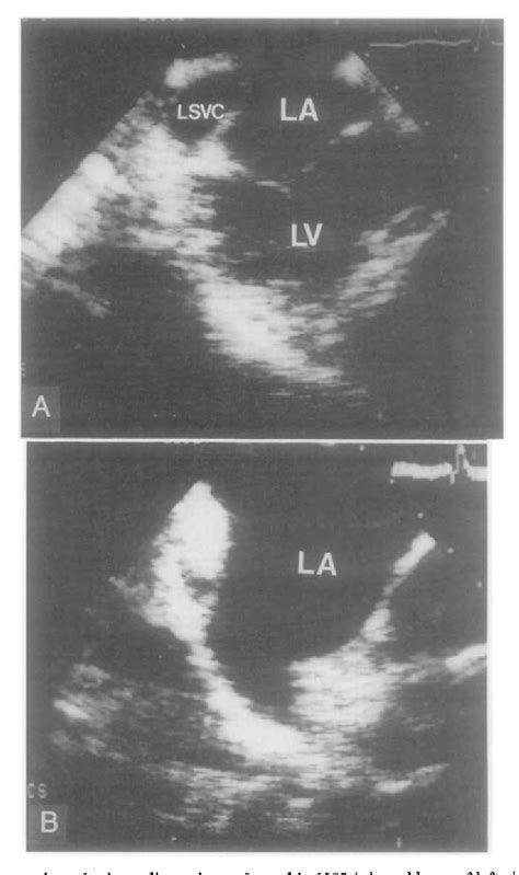 Figure 1 From Detection Of Left To Right Shunt In Atrial Septal Defect