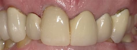 endo post core crown      cdocs
