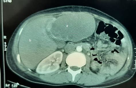 Abdominal Ct Scan Showing A Hydatid Cyst Of The Left Lobe Of The Liver Download Scientific