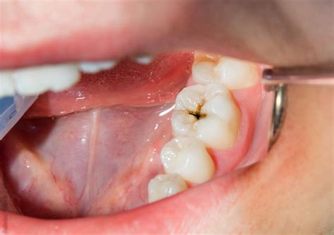 Tratamentos para a cárie tudo o que você precisa saber CVDentus