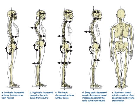 How to address the root cause of Swayback Posture: Exercises + Tests