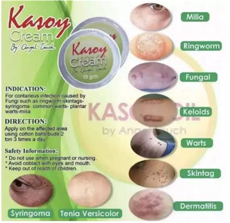 Kasoy Cream Warts Remover Grams Lazada Ph