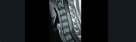 Spinal Tumors - Taylor Family Department of Neurosurgery