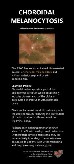 Neoplastic Choroid Disorders Choroidal Melanocytosis Retina Rocks