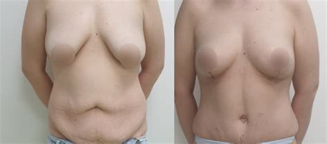 Inainte Si Dupa Before And After Abdominoplastie