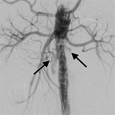 Embolization Of A Type Ia Endoleak Due To Infolding Of The Polymer