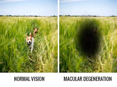 Glaucoma Vs Macular Degeneration Glaucoma Philippines