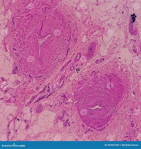 Distal Femur (biopsy). Exostosis. Section Show Mature Hyaline Cartilage