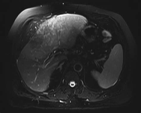 mri evaluation  masses   noncirrhotic liver applied radiology