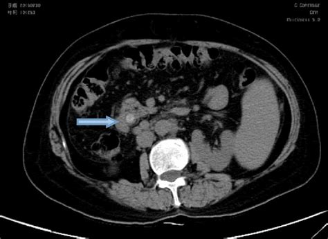 Common Bile Duct Stone Ultrasound