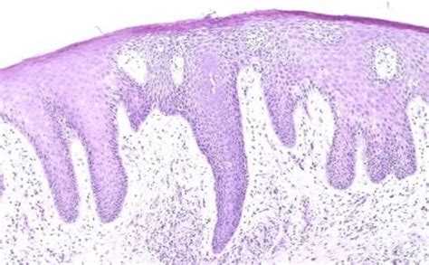 Erythroderma Secondary To Eczema Showing Hyperkeratosis Acanthosis