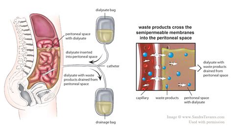 Peritoneal Dialysis | Tyneside KPA