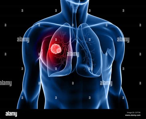 Lung Cancer X Ray Hi Res Stock Photography And Images Alamy