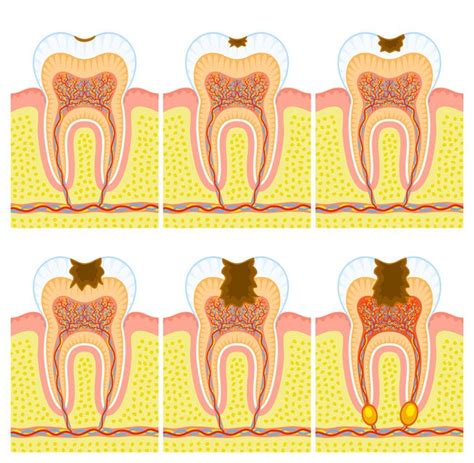 Caries interdentales qué son tratamiento y cómo detectarlas Axioma