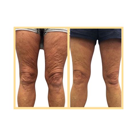 sentient sculpt body contouring  medical aesthetics med spa