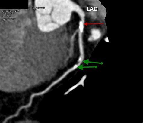 imagecontrast ct showing coronary artery disease merck manual