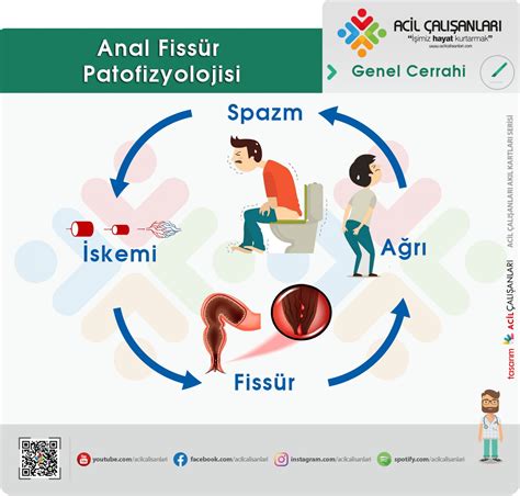 Anal Fissür Acil Yaklaşım Acil Çalışanları