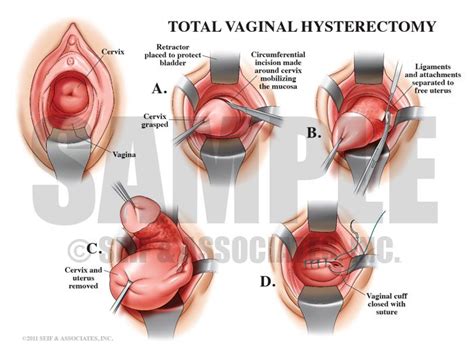 Diagram Of Female Reproductive System After Hysterectomy Hys