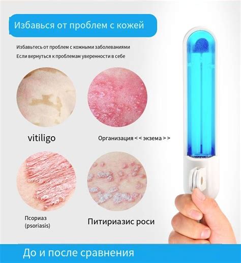 311nm ультрафиолетовые лампы, для лечения псориаза, вилитиго, экземы ...