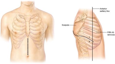 Ivor Lewis Esophagectomy | Thoracic Key