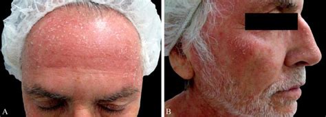 A And B Erythematous Papules And Plaques With Superficial Scaling On