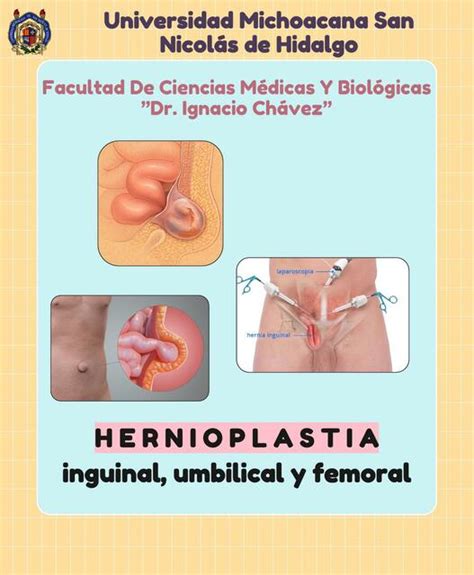 Hernioplastia Inguinal Umbilical Y Femoral Hernias Javier Rios Udocz