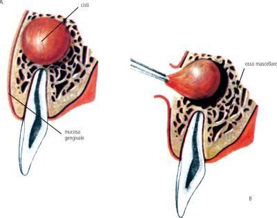 O Que É Cistectomia - Cistectomia: definizione e significato medico | Corriere Salute