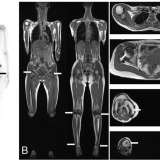 osteonecrosis   bilateral hip knee  ankle joints