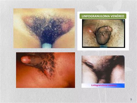 Sindrome Ulceroso Genital Y Adenopatias Ppt