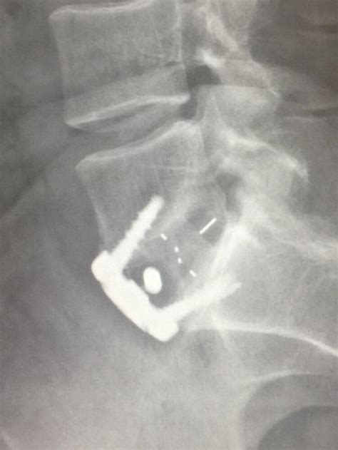 9 months post op L5-S1 anterior spine fusion... caused by doing surgery ...