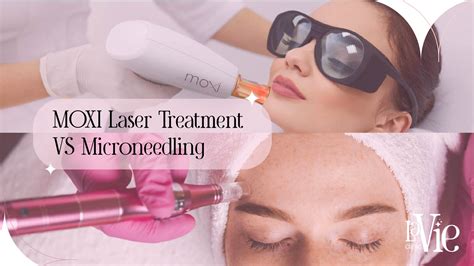 Moxi Laser Treatment Vs Microneedling N And R Lavie Clinic