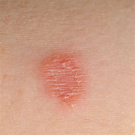 Circular Rashes That Aren’t Ringworm, According to Doctors