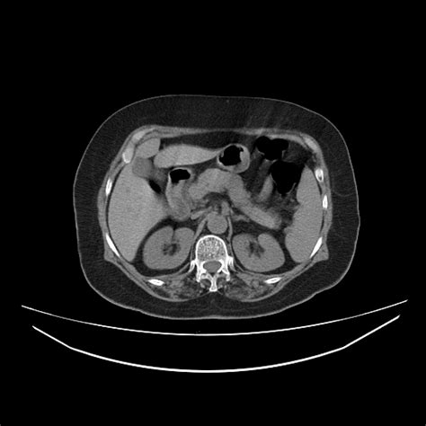Splenic Artery Aneurysms Image