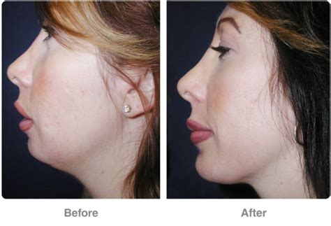 Mentoplasty Chin Surgery Plastic Surgery