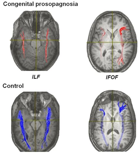 what's face blindness 4
