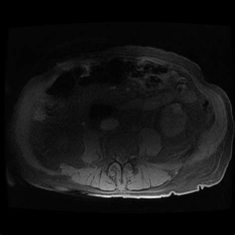 File:Journey through necrotizing pancreatitis - presentation, walled ...