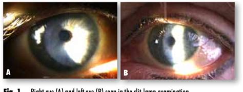 Figure 1 From Cornea Verticillata A Rare Complication Of Chloroquine