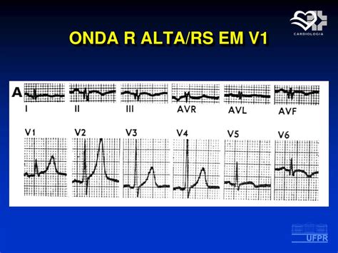 PPT - Cardiopatia Isquêmica Eletrocardiograma PowerPoint Presentation