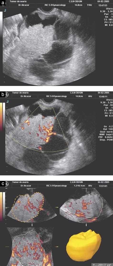 Tumor Angiogenesis Assessed By Three‐dimensional Power Doppler