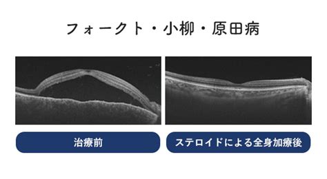 ぶどう膜炎とは？ - 目の病気よろず相談室｜九州大学 眼科