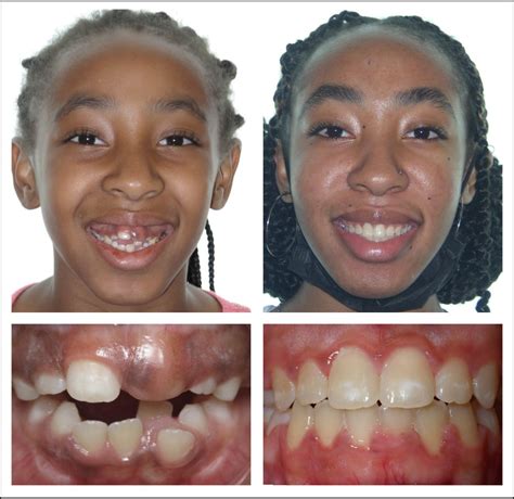 Transforming Smiles Before And After With The Herbst Appliance Omkelly