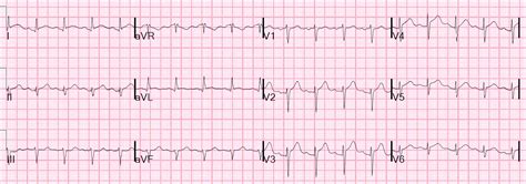 Dr Smiths Ecg Blog Chest Pain Sinus Tachycardia And St Elevation