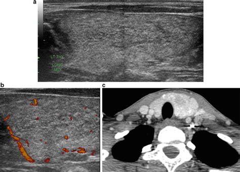 Pattern Recognition Of Benign And Malignant Thyroid Nodules Ultrasound Characteristics And