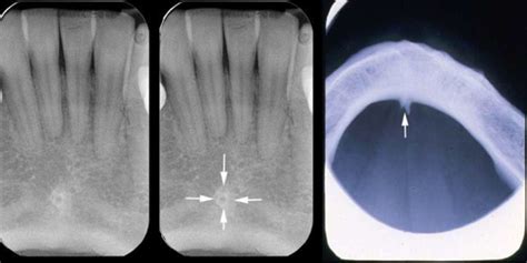 Genial Tubercle Radiograph