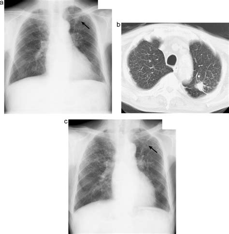 Complications Of Pneumoconiosis Radiologic Overview European Journal