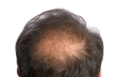 Alopecia In Men Causes Symptoms And Other Risk Factors