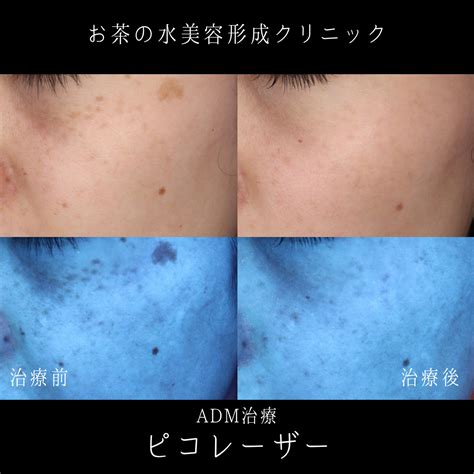 こんなシミはありませんか？ADMというシミについて。 | 御茶ノ水の美容皮膚科｜お茶の水美容形成クリニック