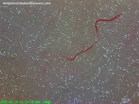 Morgellons Updated Info About That Creepy New Disease Divinewiz
